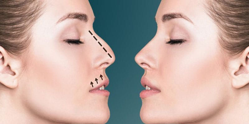 The Benefits of Manual Lymphatic Drainage After Rhinoplasty You Need to Know