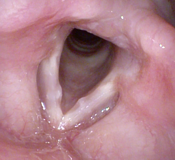 Vocal nodules, Larynx