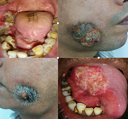Oral Cancer, Tongue Cancer