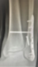 Healed ankle fracture from surgery