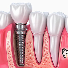 Dental İmplant Tedavisi