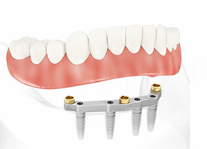 Removable Denture on Fixed Implant Bar