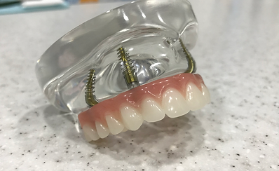 Implant Denture