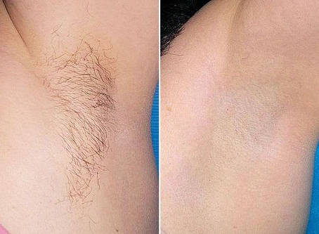Triệt lông nách bao nhiêu lần thì hết? Giải mã lộ trình sạch lông vĩnh viễn
