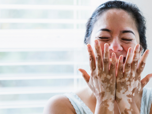 Celebrating Courage and Awareness: World Vitiligo Day
