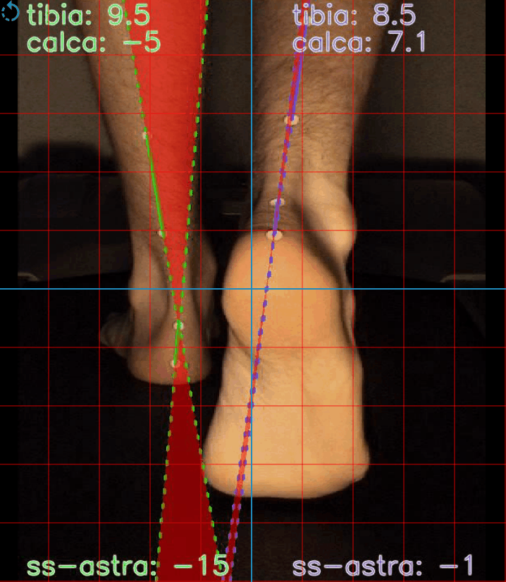 video gait analysis system with goniometry