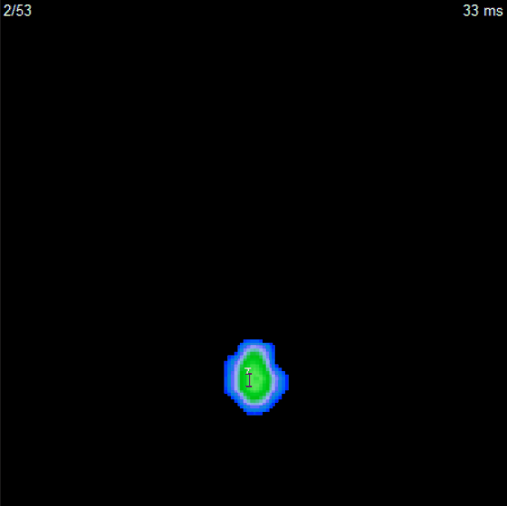gait analysis pressure mapping 
