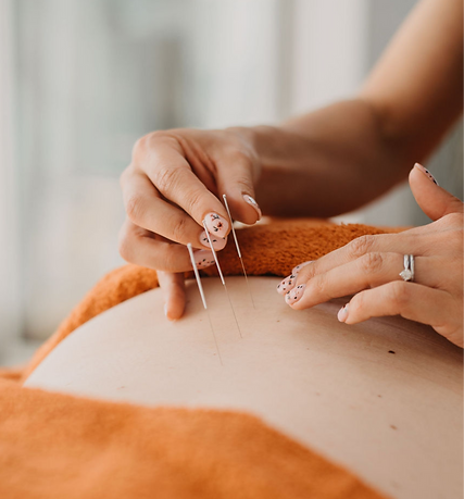 Acupuncture for back pain, acupuncture needles in back.