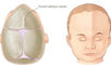 Cranial stenosis and unilateral in-toeing in a 6-year-old male: A case report