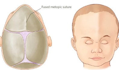 Cranial stenosis and unilateral in-toeing in a 6-year-old male: A case report 