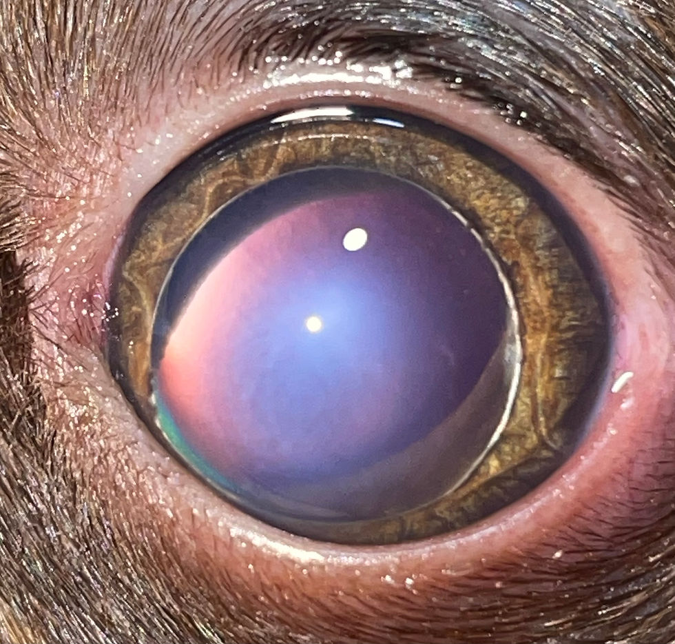 Luxación del cristalino