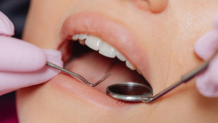 Understanding the Outgassing of Mercury Amalgam Fillings and Its Health Implications