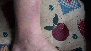 Dermatology issue resolved with herbal medicine!