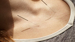 Acupuncture's Role in Transforming Standard of Care Medicine