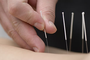 acupuncture, nyc