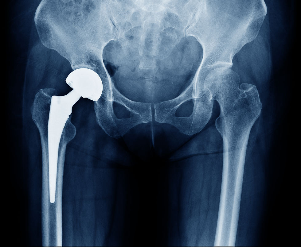 X-ray scan image of hip joint with orthopedic hip joint replacement or total hip prosthesis on right side showing Implant head and screws In female human skeleton.