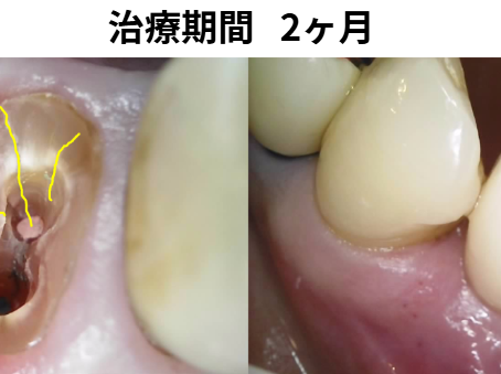 歯が折れてオペから2ヶ月で治療を終えた症例