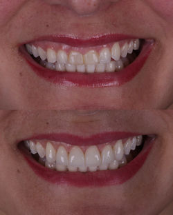 antesdepoissara.001