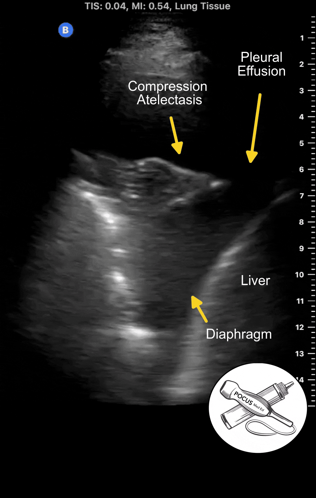 Pleural_effusion_V1.gif