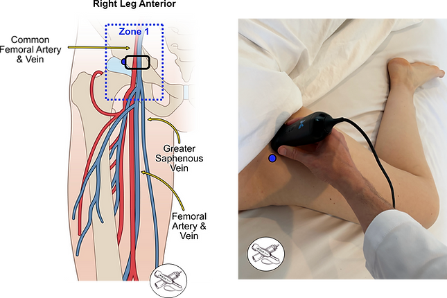 Website Lower Extremity DVT Zone 1 Overview CFV.png