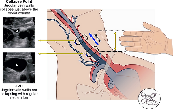 Website Measuring JVD Height_edited_edit