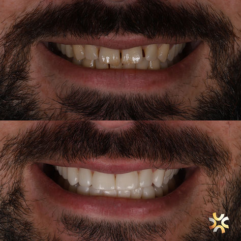 Antes e depois - Um sorriso muda tudo!