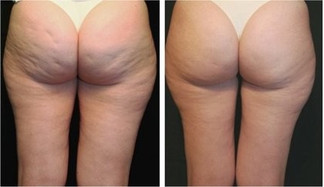 Cellulite BA womangluts.jpeg