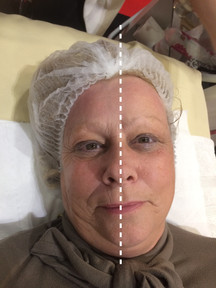 CryoFacial