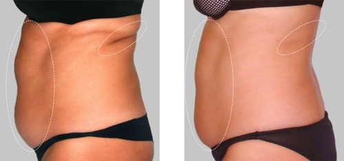 Cryo BA womanabdomen2.jpeg