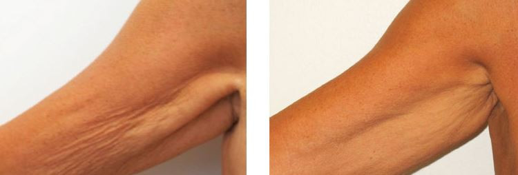 Tightening BA womanarm3.jpeg
