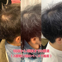 育毛3回目