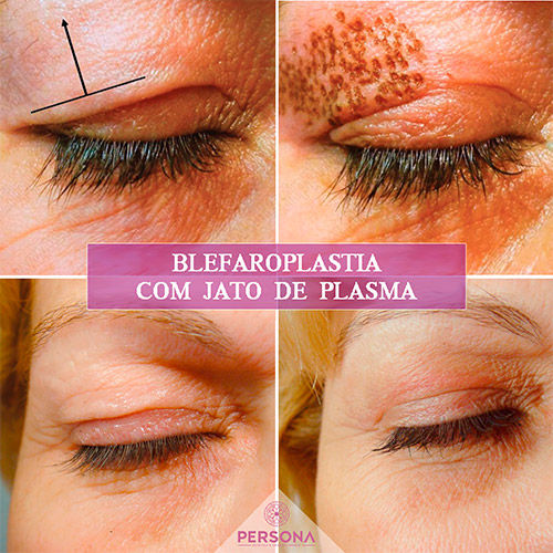 JATO DE PLASMA