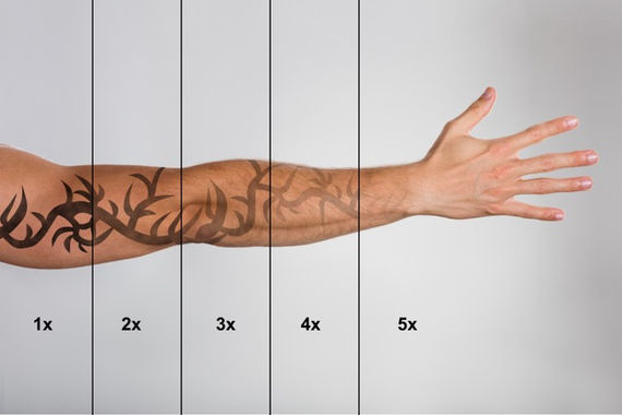 Grâce à l'acide lactique, on peut enlever les tatouages progressivement. Tatouage sur le corps, homme, femme, sur la hanche, dans le dos, sur le bras, sur les mains, sur les jambes, sur les pieds, Gradignan, Bordeaux, Aquitaine, Mérignac, Villenave d'Ornon