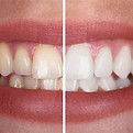 whitening.jpeg