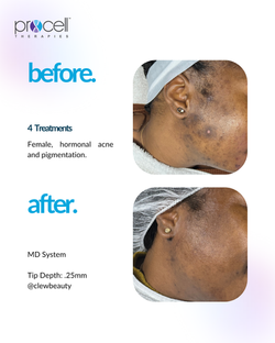 Hyperpigmentation
