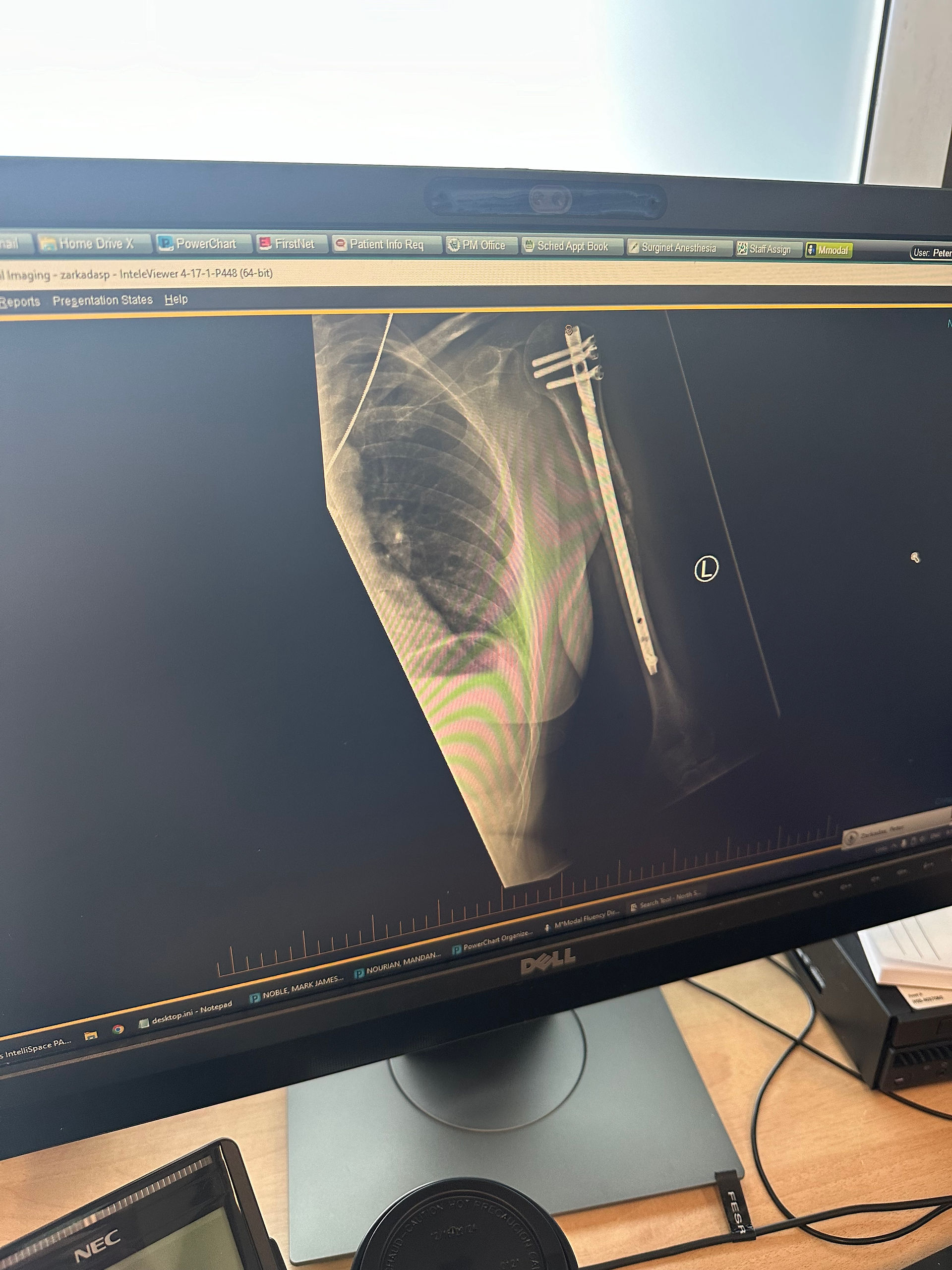 X-Ray post stabilization surgery.