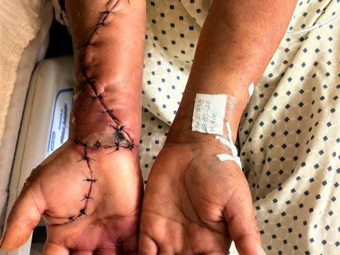 Salvan brazo de mujer tras mordedura de araña violinista