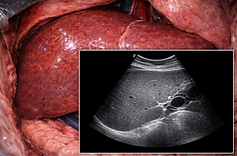 malwa diagnostic Liver UltraSound