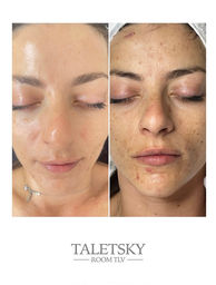 pigmentation correction Ruby laser