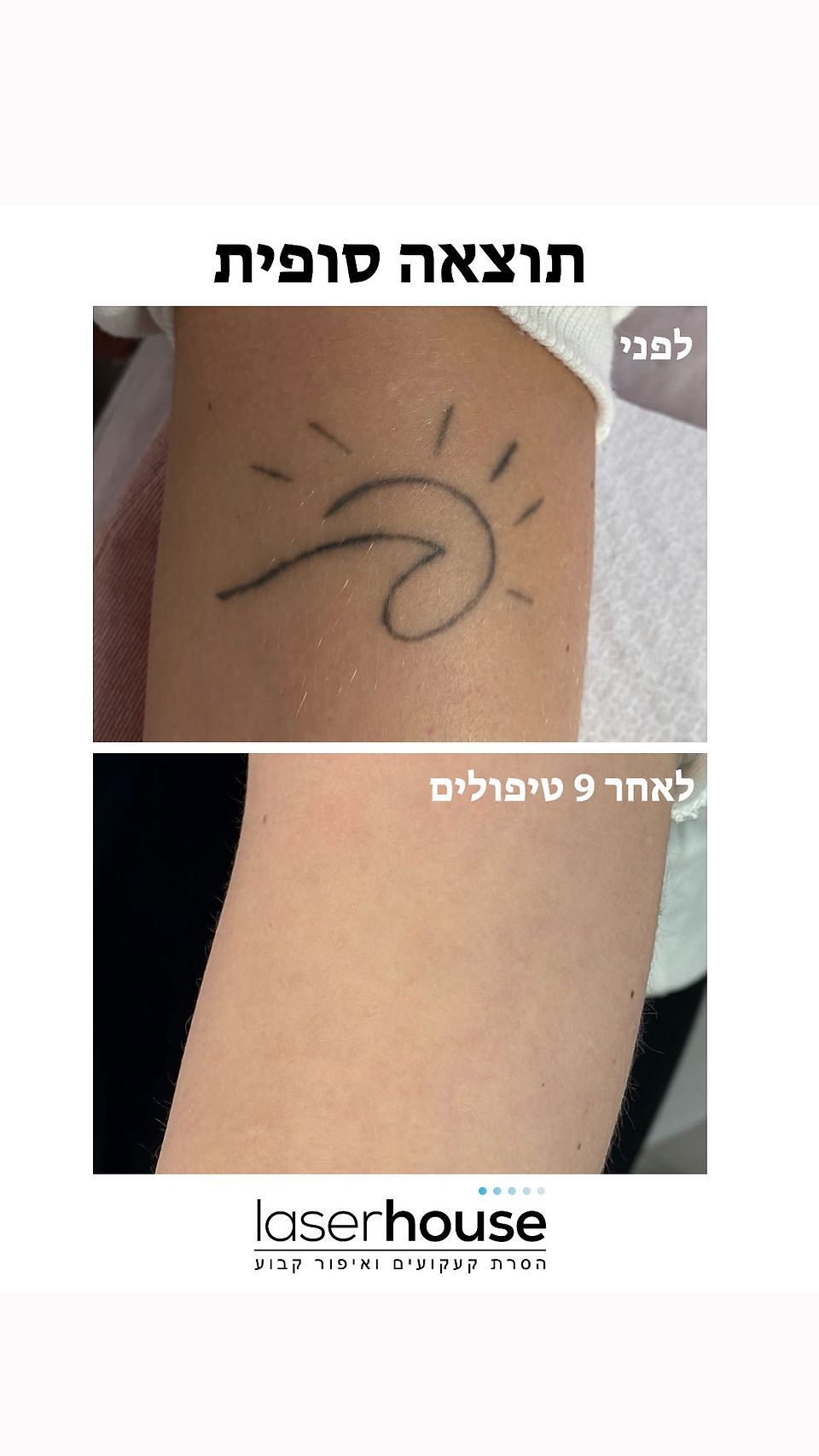 תוצאה סופית של הסרת קעקוע בלייזר: קעקוע גל לפני ואחרי 9 טיפולים
