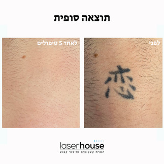 הסרת קעקוע בלייזר: לפני ואחרי 5 טיפולים