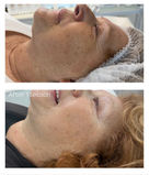 Sunspot removal