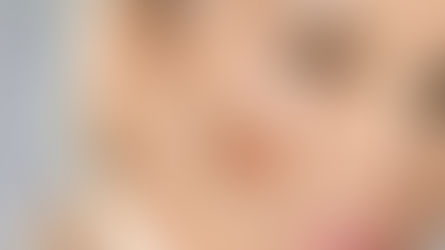 Pigmentation Removal with Quanta System  Laser 