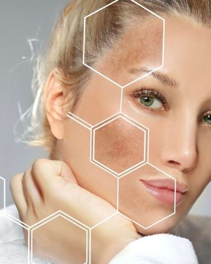 Pigmentation Removal with Quanta System  Laser 