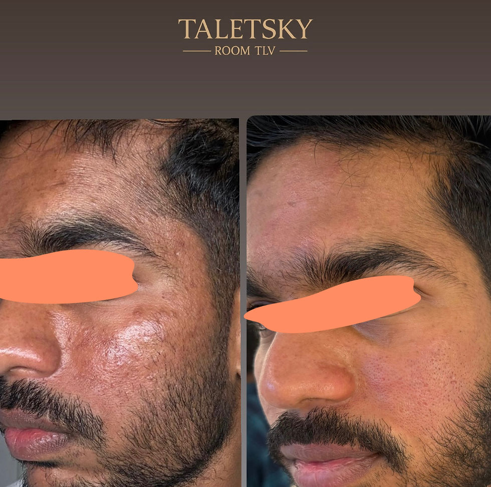 Say Goodbye to Pigmentation with Quanta System Laser at TALETSKY ROOM TLV
