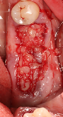 Suturing