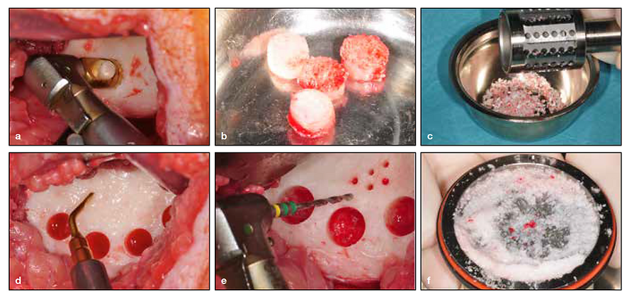 Autogenous bone sample