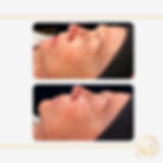 Pre & Post DiamondGlow