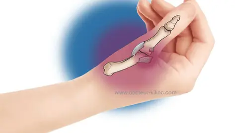 Entorse du pouce (ligament collatéral ulnaire / pouce du skieur)