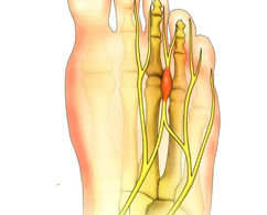 Illustration du pied montrant l’irritation nerveuse entre les orteils (névrome de Morton)

